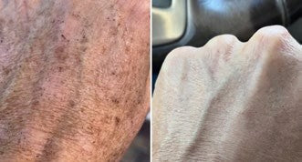Behandlungsergebnis DERMAFORCE BBL PRO 1
