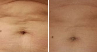 Behandlungsergebnis DERMALIFT PRO 1