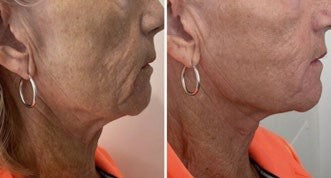 Behandlungsergebnis DERMALIFT PRO 3