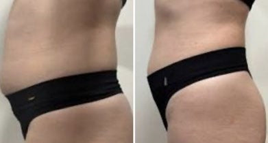 Behandlungsergebnis MUSCLEFORCE 1