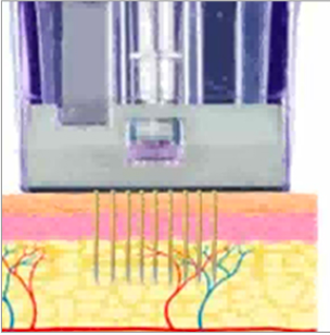 Micronneedling Vorgang