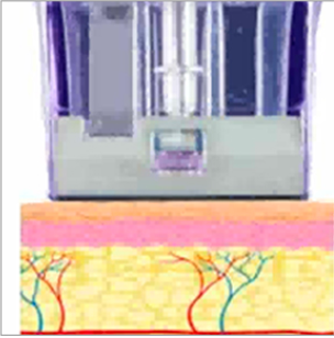 Micronneedling Vorgang