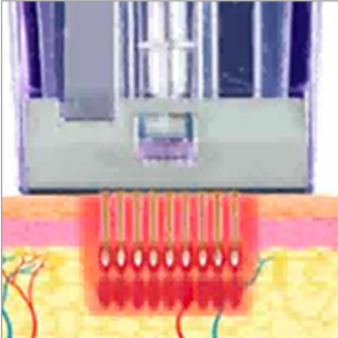Micronneedling Vorgang