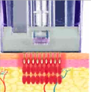 Micronneedling Vorgang