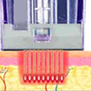 Micronneedling Vorgang