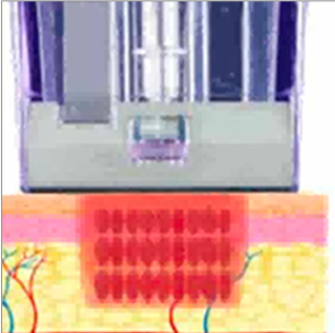 Micronneedling Vorgang