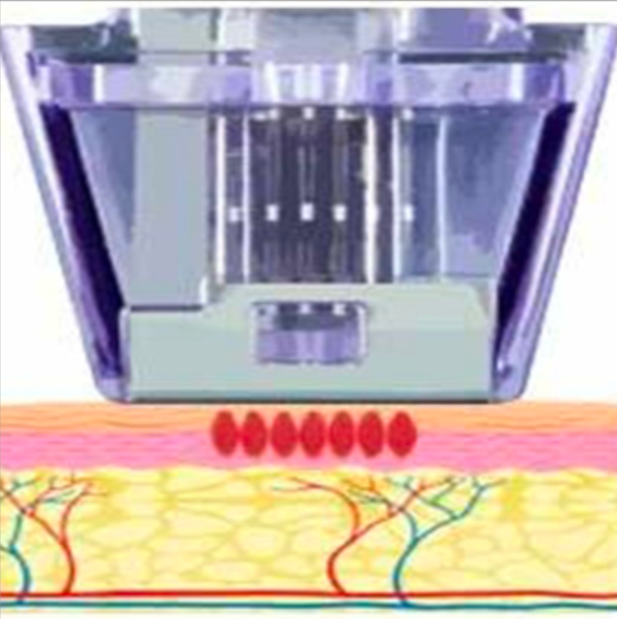 Micronneedling Vorgang
