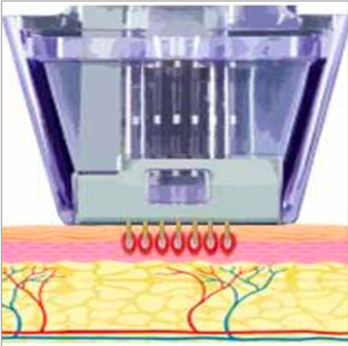 Micronneedling Vorgang