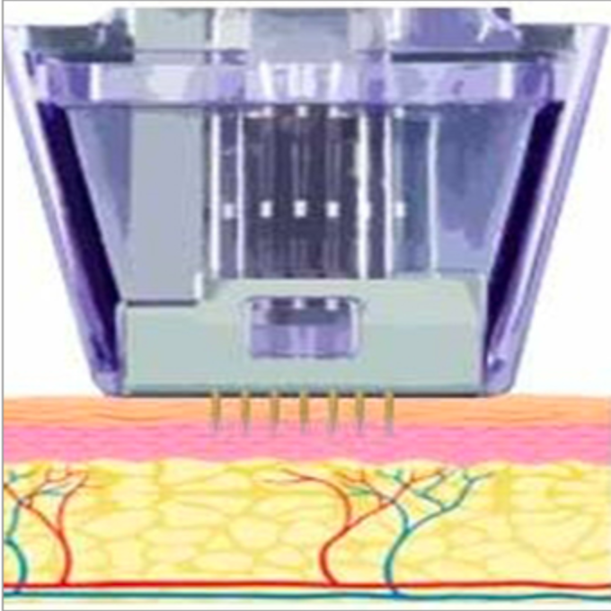 Micronneedling Vorgang