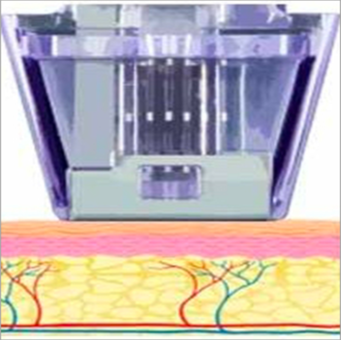 Micronneedling Vorgang