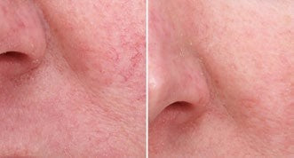 Treatments & results – DERMAFORCE BBL PRO 2