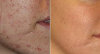 Treatments & results – DERMAFORCE BBL PRO 4