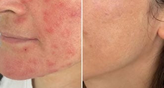 Treatments & results – DERMAFORCE BBL PRO 5