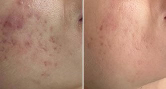Treatments & results – DERMAFORCE BBL PRO 6