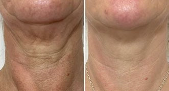 Behandlungsergebnis DERMALIFT PRO 2