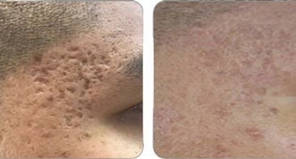Behandlungsergebnis EUPHEUS V 2