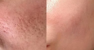 Treatments & results – FRACO CO2 XL 2