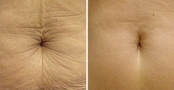 Behandlungsergebnis SIACSKIN x Velaslift 1