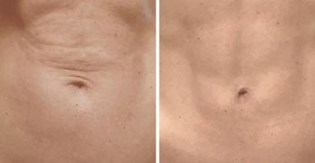 Behandlungsergebnis SIACSKIN x Velaslift 2
