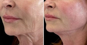 Behandlungsergebnis SIACSKIN x Velaslift 3